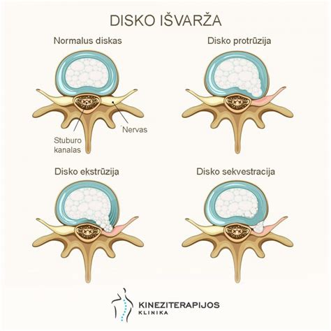 Stuburo išvarža MRT nuotraukoje