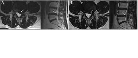 Stuburo išvaržos schema