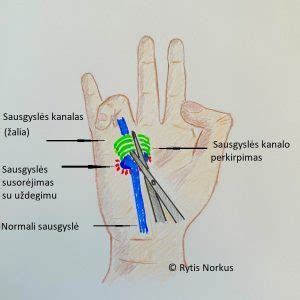 Sveikimas po operacijos