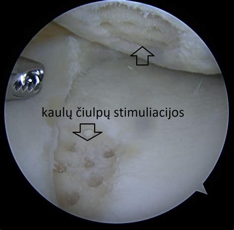 Užpakalinio kryžminio raiščio plyšimas