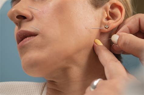 Veidinio nervo neuropatija