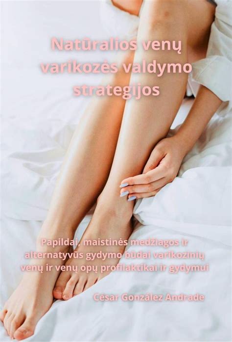 Venų varikozės infografija